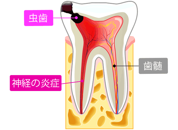 歯 の 神経 炎症