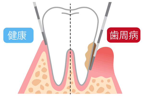 歯 周 病 を 自分 で 治す