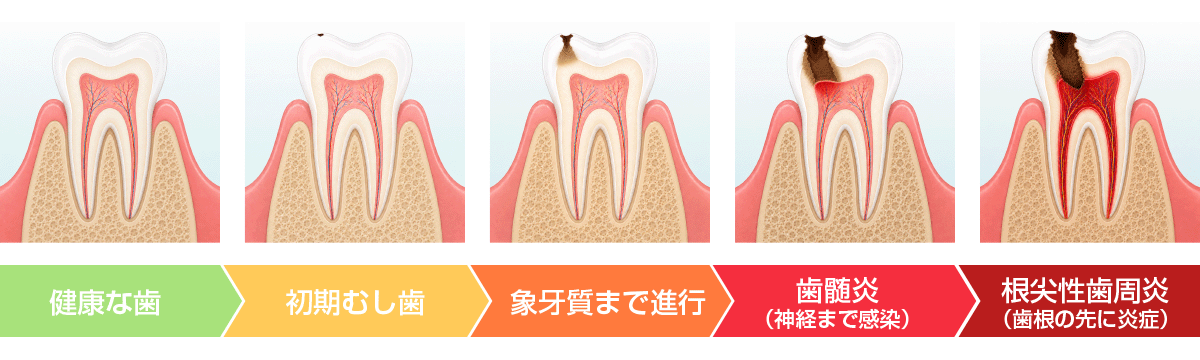 歯の根の病気の図解。神経の炎症から根の先の病巣まで、歯の内部で炎症が進んでいく様子