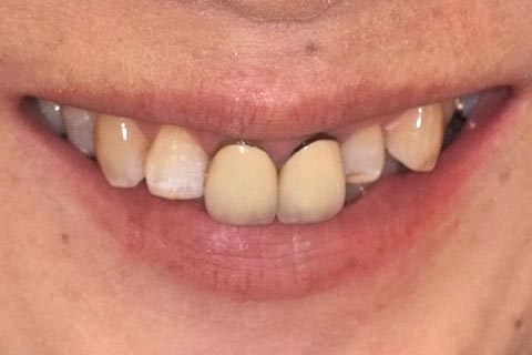 初診時の口腔内写真