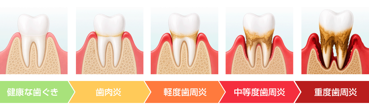 歯周病の進行段階の図解。健康な状態から重度まで、歯ぐきと歯を支える骨が失われていく様子